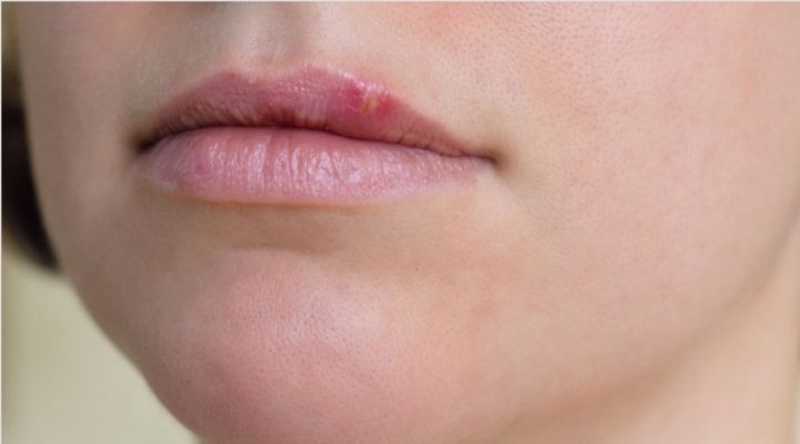 Can I live a normal life with herpes?